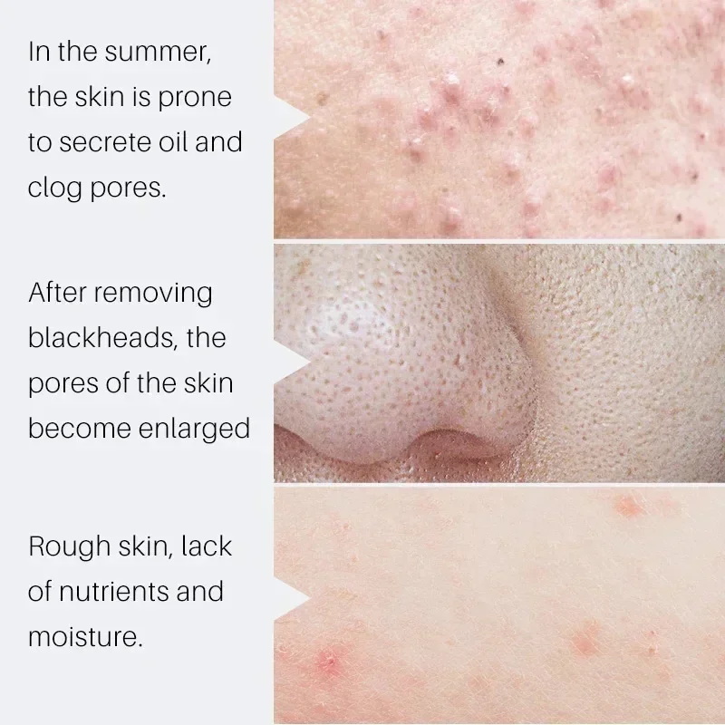 Salisilik Asit Gözenek Sıkılaş - Salicylic Acid Blackhead Remover incelemesi ve fiyatı