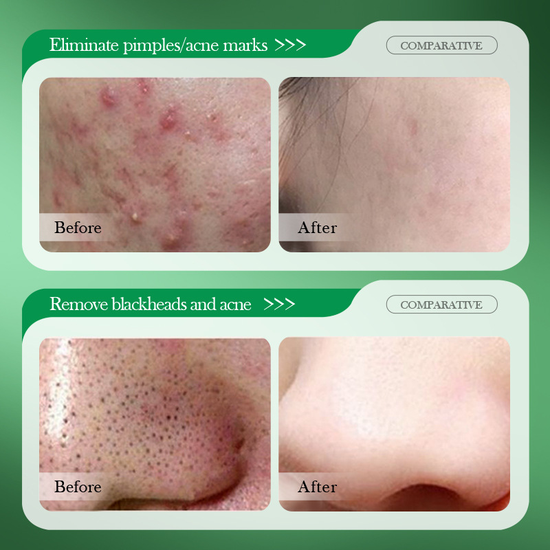 Salisilik Asit Akne Tedavi Kre - Salicylic Acid Blackhead Remover incelemesi ve fiyatı