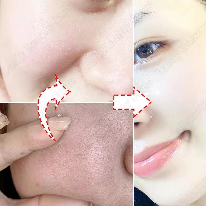 Salisilik Asit Gözenek Temizle - Salicylic Acid Blackhead Remover incelemesi ve fiyatı