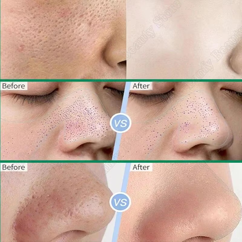 Salisilik Asit Gözenek Temizle - Salicylic Acid Blackhead Remover incelemesi ve fiyatı